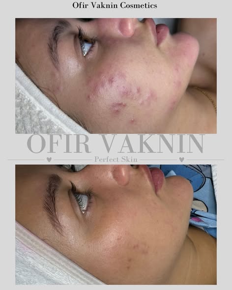 דרוש הסרת שיער בטכנולוגיות מתקדמות בבאר שבע